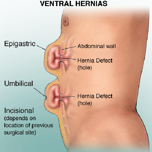 hernia3